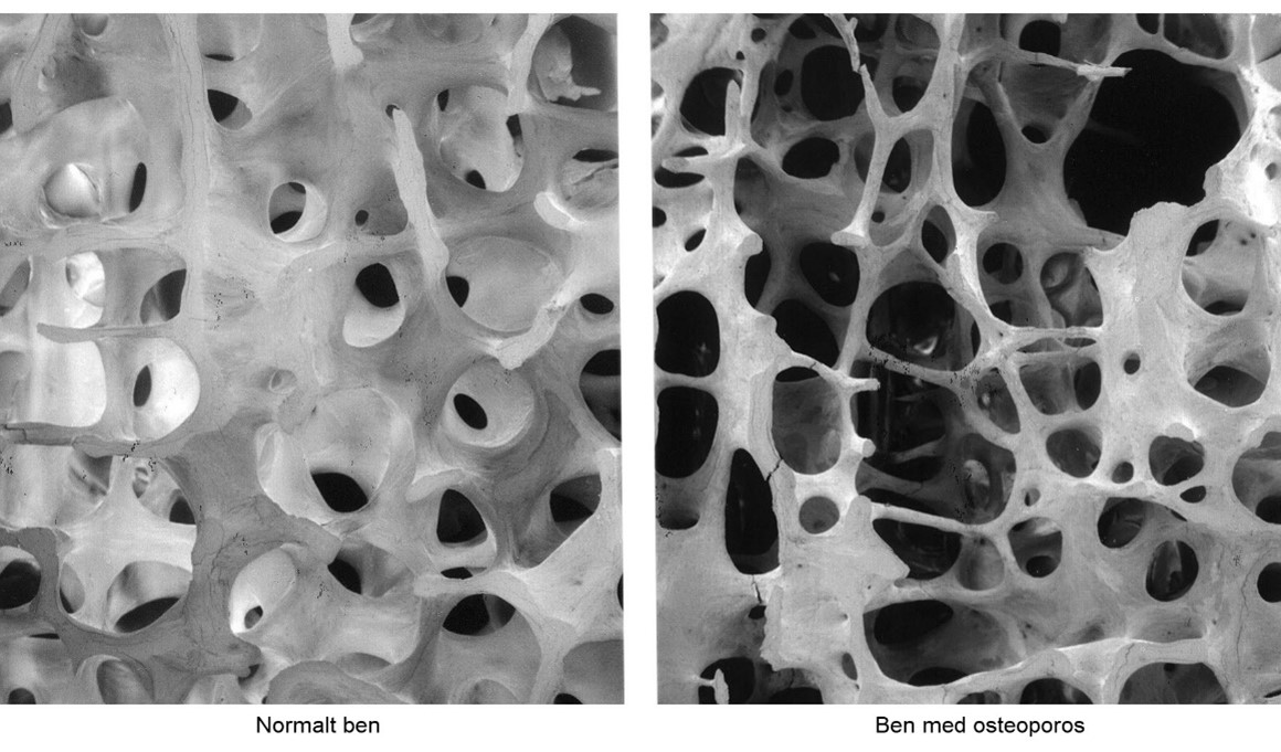 osteoporosben