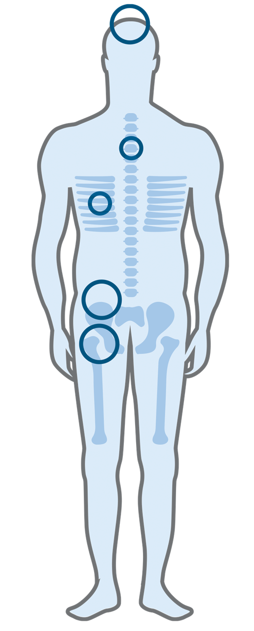Skelettillustration som visar var i kroppen myelom uppträder.