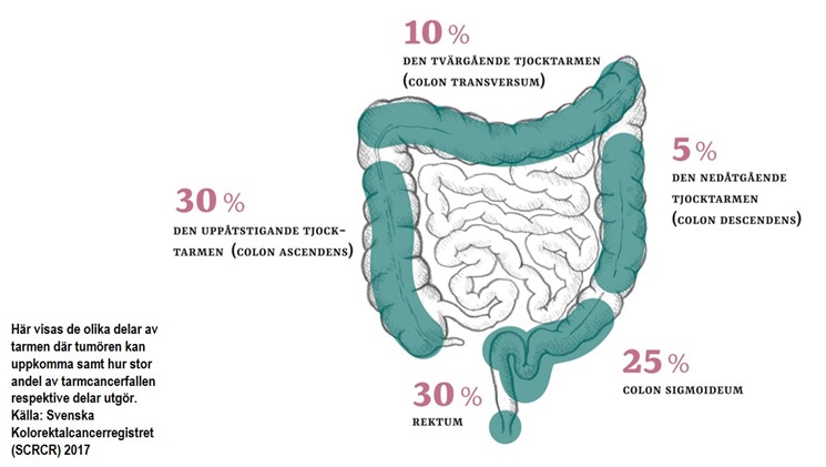 Illustration tjocktarm